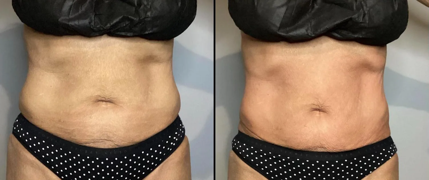Before and after photos of a client's abdomen, front view