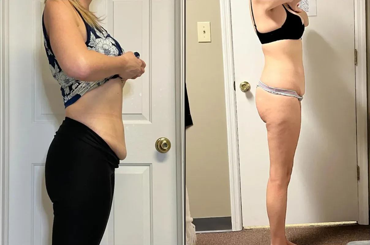 Before and after photos of a client's abdomen, side view