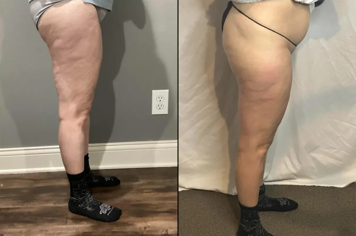 Before and after photos of a client's thigh and buttock, side view